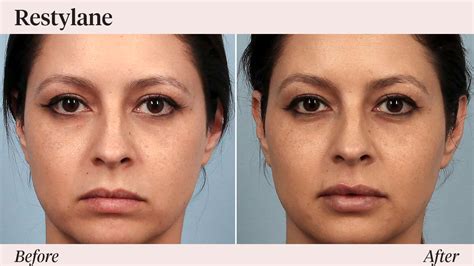 Restylane Under Eye Filler Before And After All You Need Infos