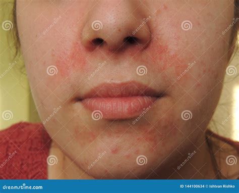 Redness Of The Skin On The Girl S Face Stock Photo Image Of Medicine