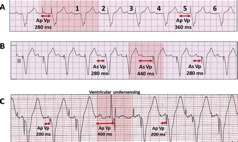 Electrocardiographic Interpretation Of Pacemaker Algorithms Enabling