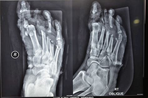 Bilateral Crush Injury Foot Free Gracilis Flap Coverage K Wire