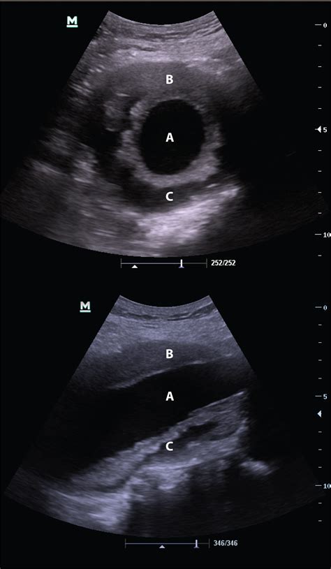 Cureus Point Of Care Ultrasound Trumps Computed Tomography In A Case