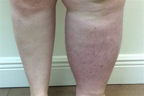 Lymphedema Causes One Leg Larger Naples Cardiac And Endovascular Center