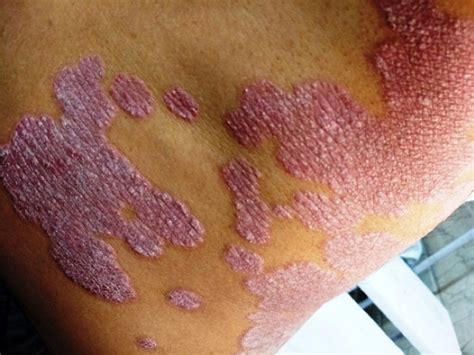 Land Map Type Scaly Erythematous Psoriatic Lesions On Side Of Abdomen