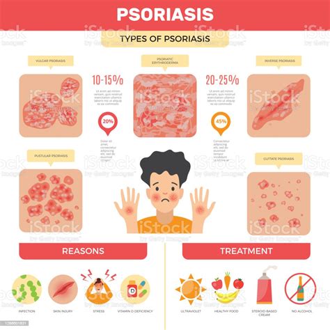 Psoriasis Infographic Human Skin Infection Psoriasis Diagnosis Vector