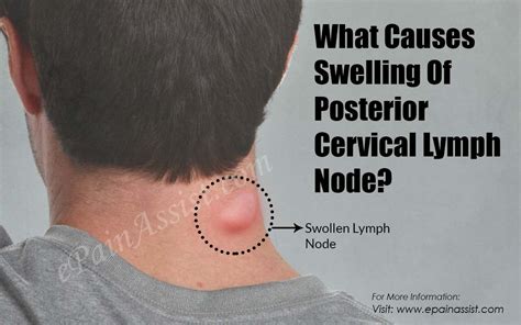 Swollen Posterior Cervical Lymph Nodes In Neck Slideshare