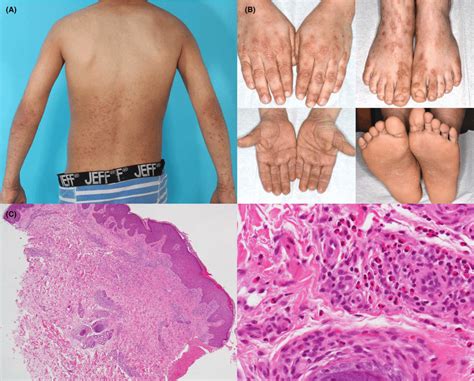 A Generalized Dermatitis With Papulonodular Skin Rash On The Extensor