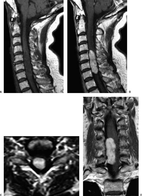 63 Large Intraduralextramedullary Cervical Spine Tumor Neupsy Key