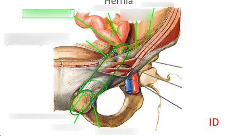 Indirect And Direct Inguinal Hernias Diagram Quizlet Hot Sex Picture