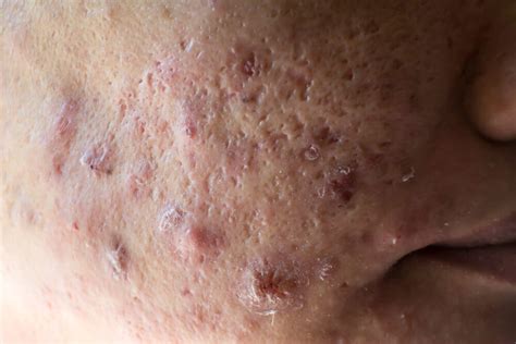 Qué es el acné quístico Mejor con Salud