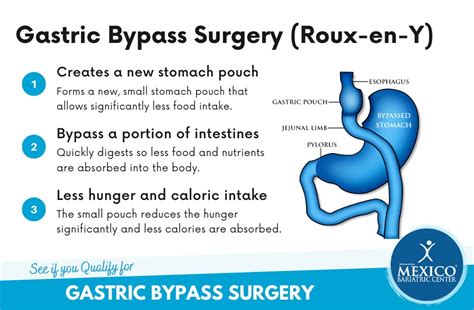 Roux En Y Gastric Bypass In Tijuana Mexico Starting At 5895