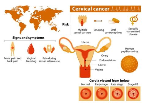 Most Women Miss These 3 Early Signs Of Cervical Cancer David Avocado