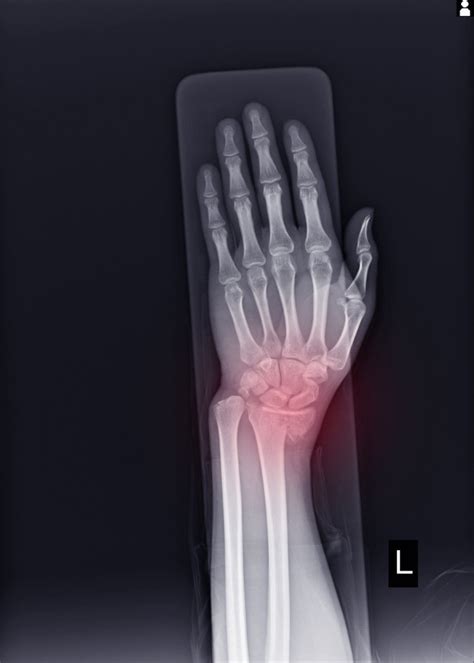 X Ray Left Wrist Joint Fracture With Displacement Distal