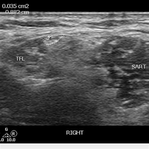 Ultrasound Localization Of The Lateral Femoral Cutaneous Nerve This