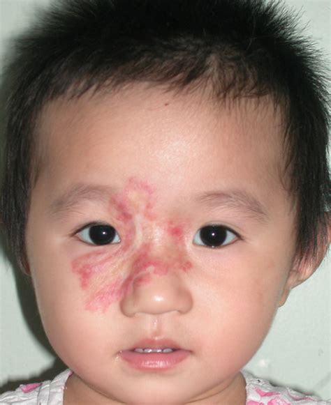 The Hemangioma Involuted One Year And Five Months After Bleomycin