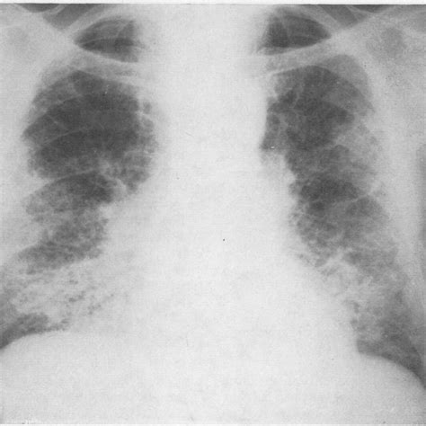 Chest Radiograph November 1967 Shows Reticulo Nodular Bilateral