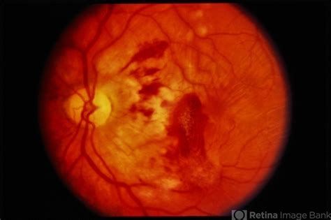 Trauma With Hemorrhages Optic Nerve Swelling Retina Image Bank