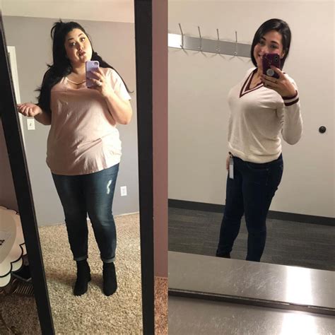 Gastric Bypass Before And After Pictures Skin The Most Inspiring