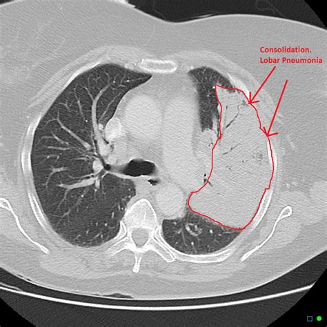 Pneumonia Chest Ct Scan