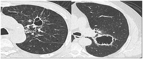 Thin‑wall Cystic Lung Cancer A Study Of 45 Cases