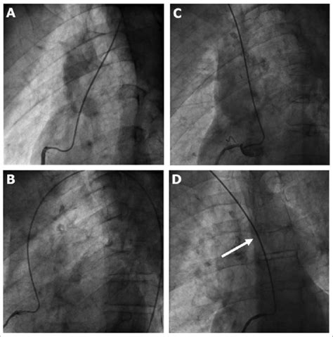 Right Coronary Artery Cannulation By Using Original And Reshaped Ar1