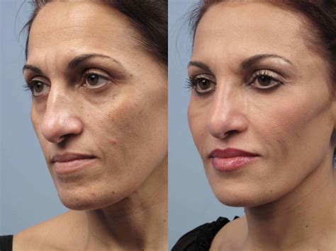 Fractional Laser Resurfacing Before After Photos The Laser Image My