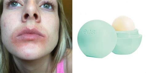 Eos Lawsuit Settled Lip Balm Company Sued