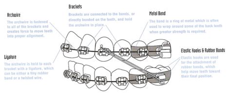 Parts Of Braces — Angle Orthodontics
