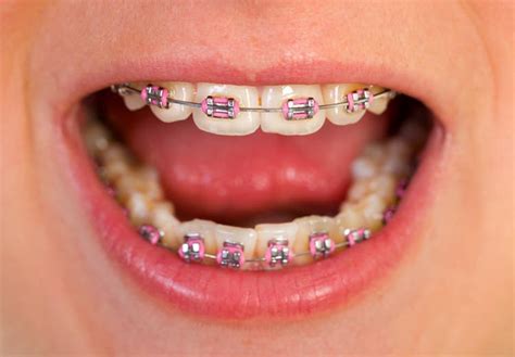 Common Types Of Braces For Adults Long Beach Ca Patch