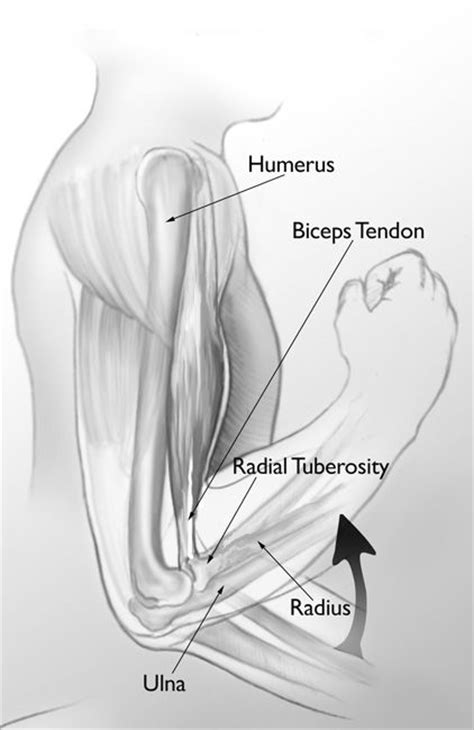 Biceps Tendon Tear At The Elbow Orthoinfo Bicep Tendonitis Tendon