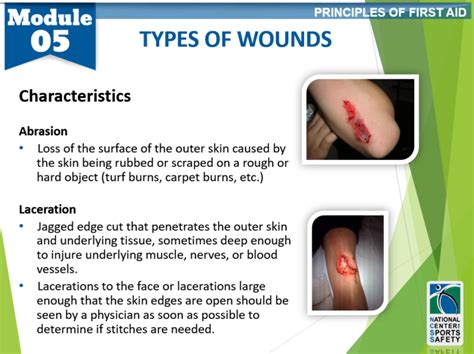 9 Types Of Wounds2 National Center For Sports Safety