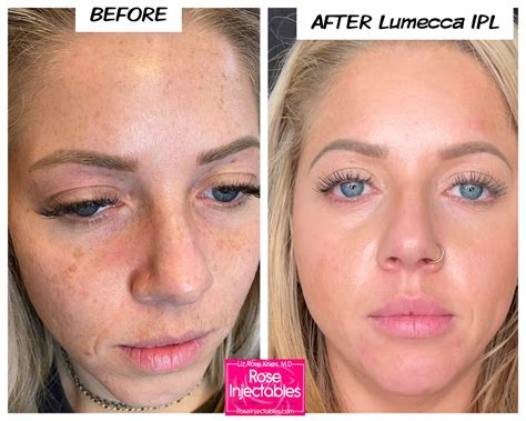 1 Med Spa In Cañon City Rose Injectables Beforeafter