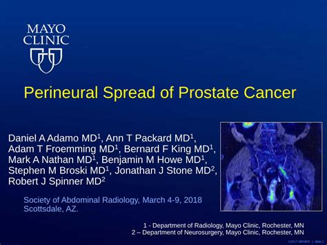 PDF Perineural Spread Of Prostate Cancer Comparing High Resolution MRI With Torso And