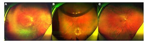 Figure 1 From Air Tamponade For Rhegmatogenous Retinal Detachment With