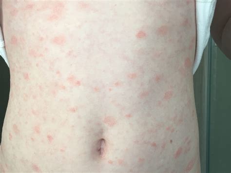 Pityriasis Rosea