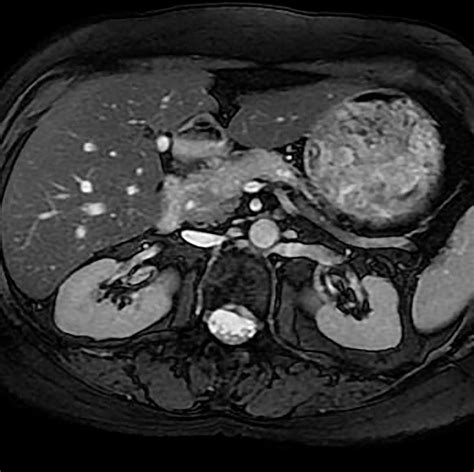 Pancreatic Adenocarcinoma Body Mr Case Studies Ctisus Ct Scanning