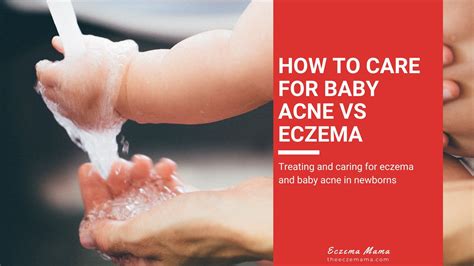 How To Care For Baby Acne Vs Eczema Eczema Mama