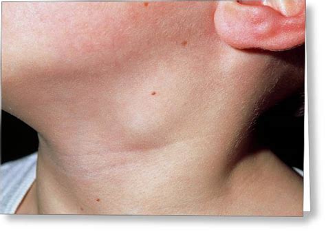 Close Up Of Swollen Lymph Node In The Neck Of Boy Photograph By Dr P