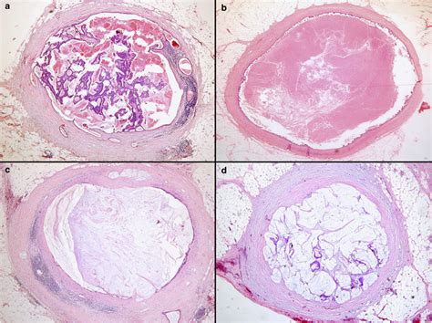 Lymph Nodes Under Complete Replacement By Metastatic Tumor Download