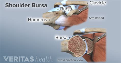 Subdeltoid Bursitis Shoulder