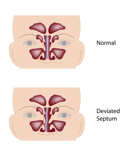 Deviation Of The Nasal Septum Polyclinique Centre Ville
