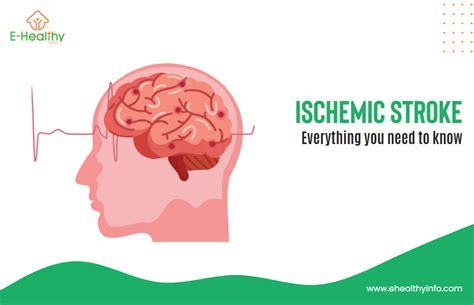 Ischemic Stroke Causes Symptoms Diagnosis And Treatment E Healthy Info