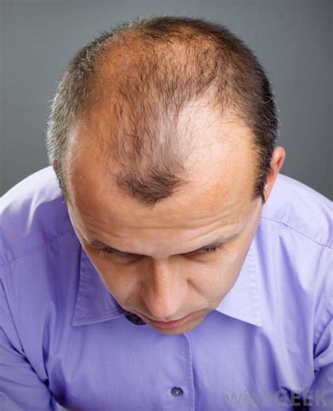 In fact it is common we shed it signals the end of the active male and female hair growth of a hair. What Is the Connection between Lysine and Hair Loss?