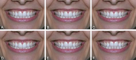 Figure From Influence Of The Vertical Position Of Maxillary Central Incisors On The Perception