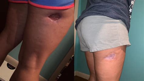 Reddit User Shares Photos Of One Womans Recovery From Brown Recluse