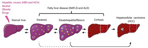 The Spectrum Of The Different Stages Of Fatty Liver Disease Fld And