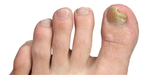 Toenail Fungus Infections Ohio Foot And Ankle Specialists 30 Podiatry