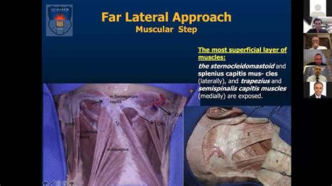 Far Lateral Approach Microsurgical Anatomy Part 2 Youtube