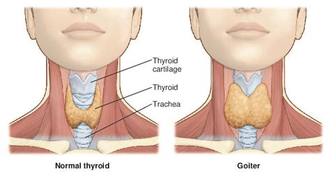 Goiter Tabers Medical Dictionary