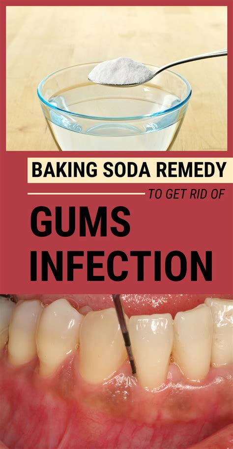 How To Treat Gum Infection At Home Onepronic