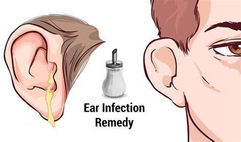 Home Remedies For Ear Infections Top 10 Home Remedies Ear Infection Ear Infection Remedy